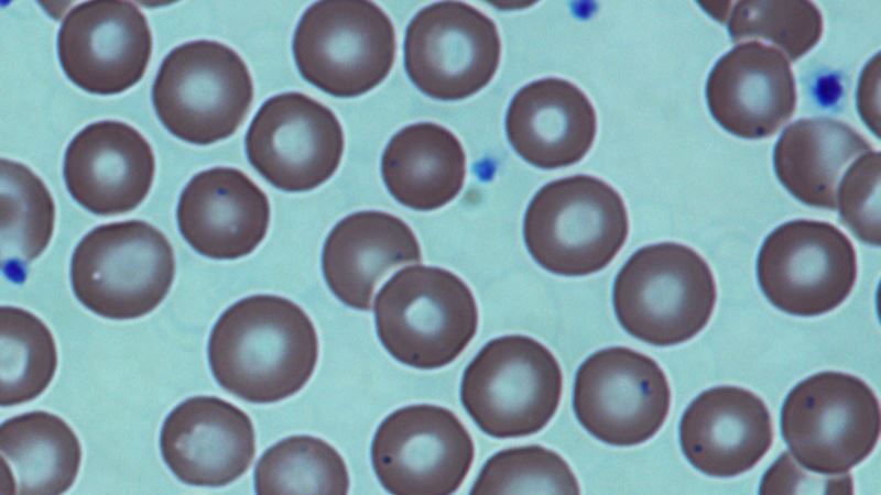 Stanford Uses CRISPR to Correct Sickle Cell, Human Trials Planned
