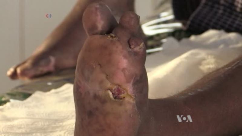 Fight Against Leprosy Continues: Case By Case