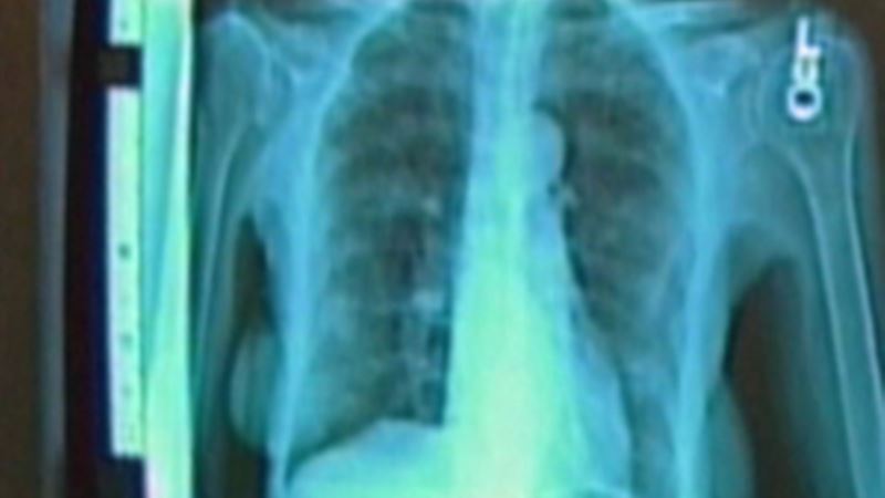 Nasal Swab Could Help Diagnose Lung Cancer