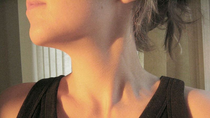 US Medical Body Recommends Against Screening for Thyroid Cancer