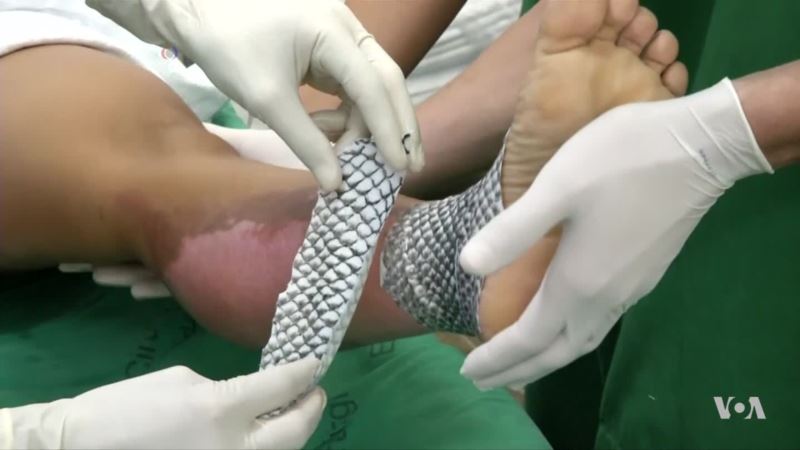 Alternative Therapy Uses Fish Skin for Burn Relief