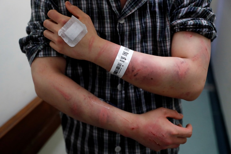 Calvin So, a victim of Sunday's Yuen Long attacks, shows his wounds at a hospital, in Hong Kong, China, July 22, 2019. 